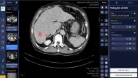 Vinbrain cùng bệnh viện ĐH Y dược TP.HCM phát hiện và chẩn đoán ung thư gan bằng AI